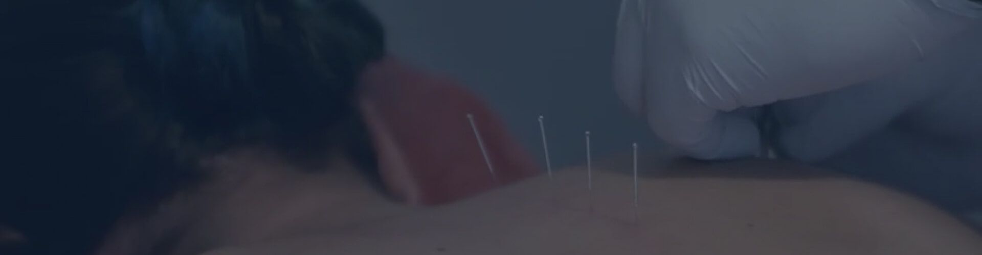 dry needling