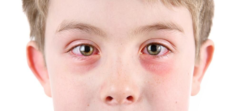 What Is The Best Way To Treat Eye Allergies?