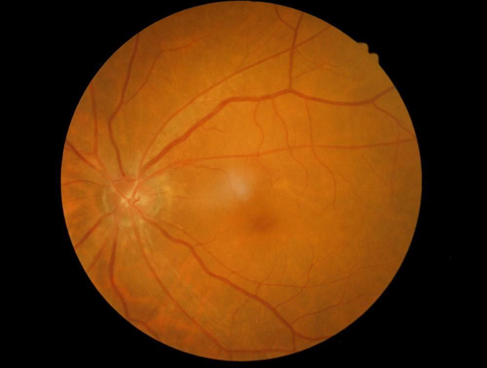 Macular Degeneration FAQs