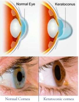 Keratoconus