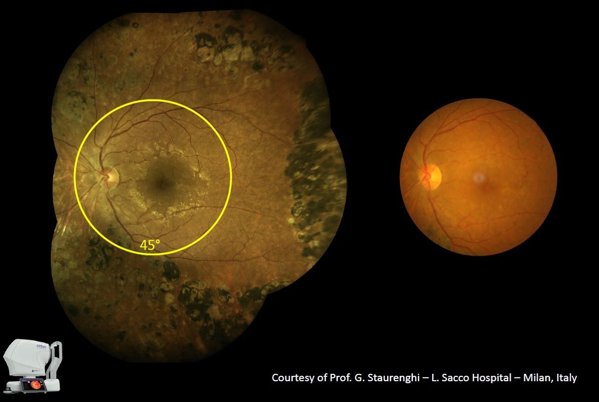 eye exam