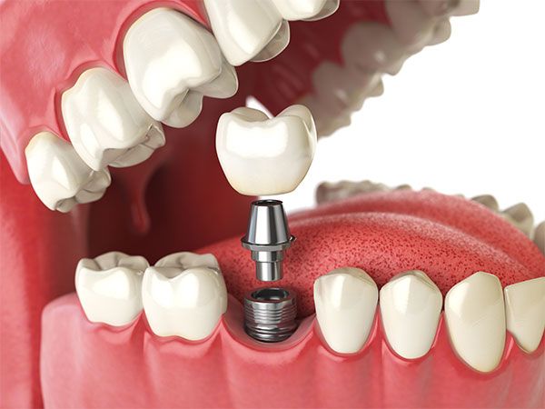 Dental Implant Care