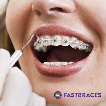 FastBraces