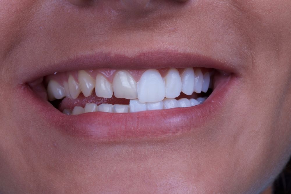 veneers