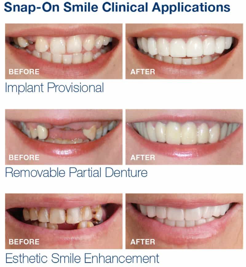 snap on smile before and after