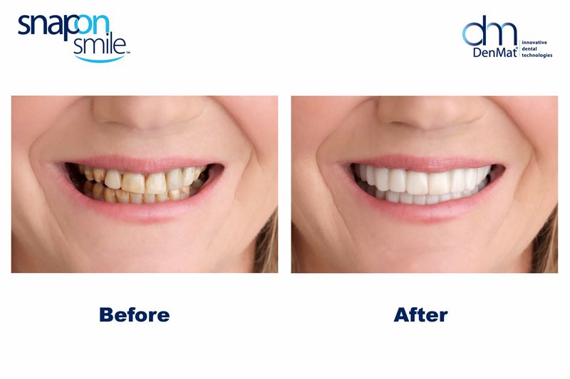 snap on smile before and after