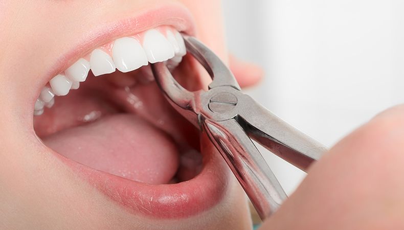 Dental Extractions