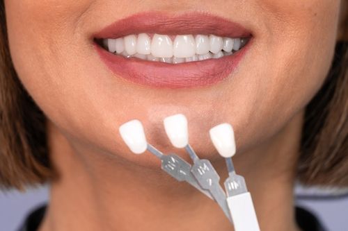 Perfecting Your Pearly Whites: The Magic of Dental Veneers