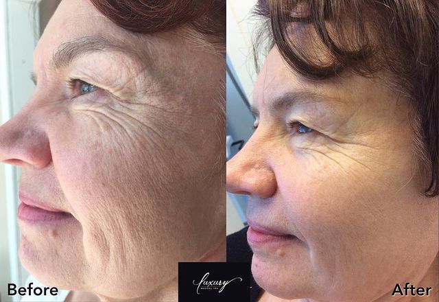 wrinkle treatment results