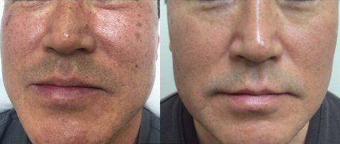 skin treatment results