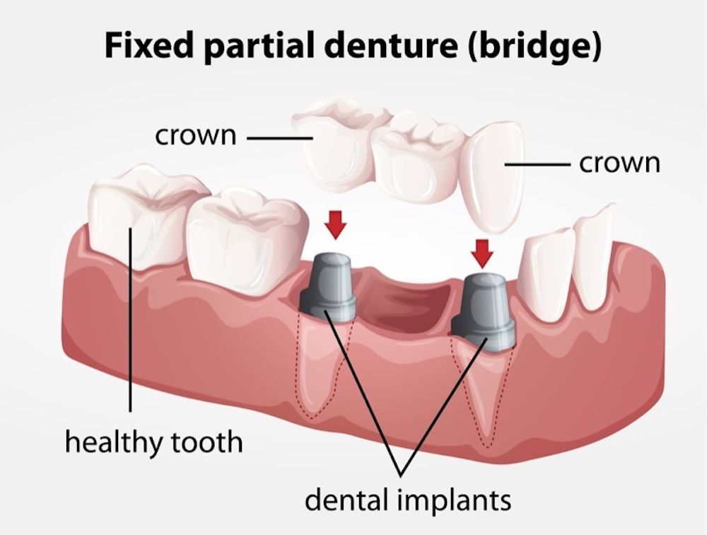 Crowns Vs. Bridges Vs. Implants: Which Is Right for Me?