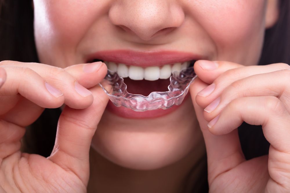 The Clear Aligner Orthodontics Process From Start to Finish