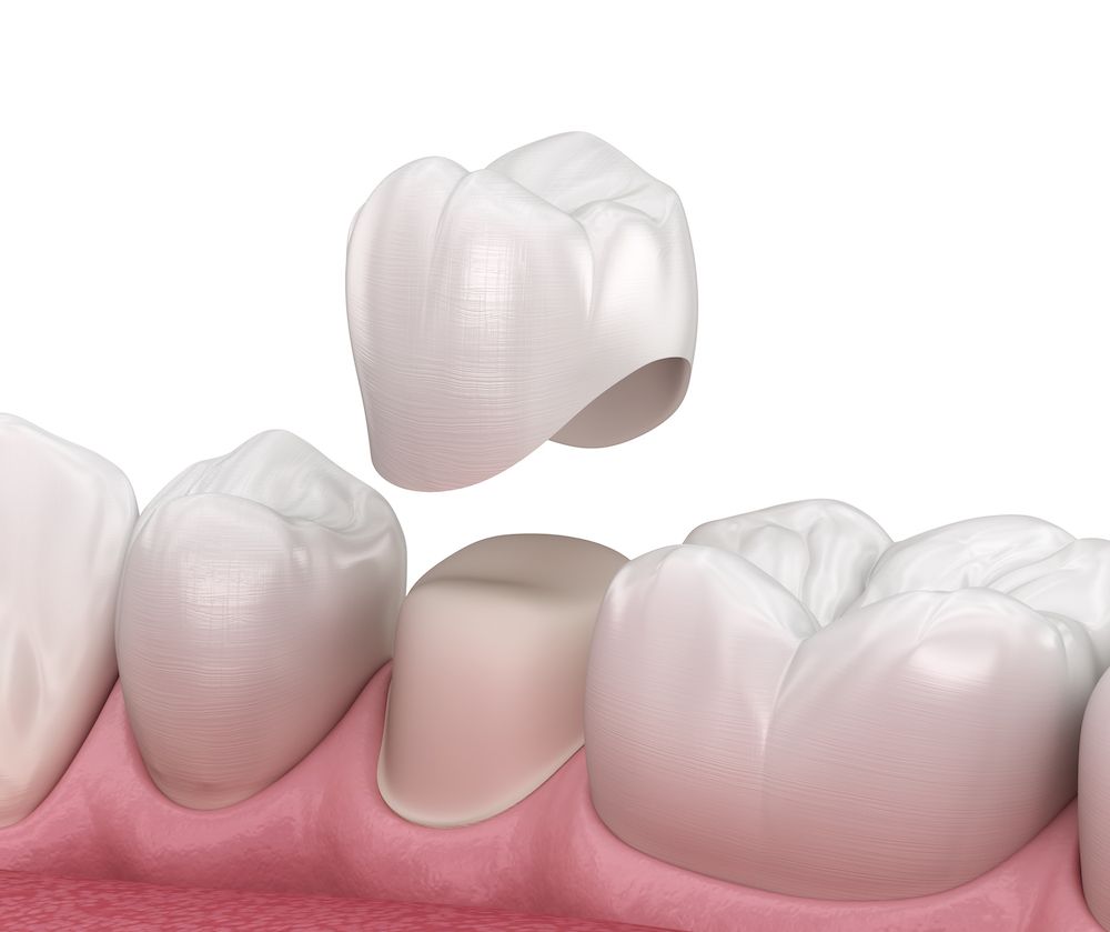 Getting a Dental Crown: What to Know