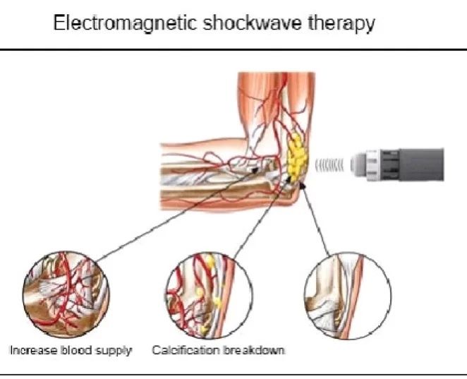 Shockwave Therapy