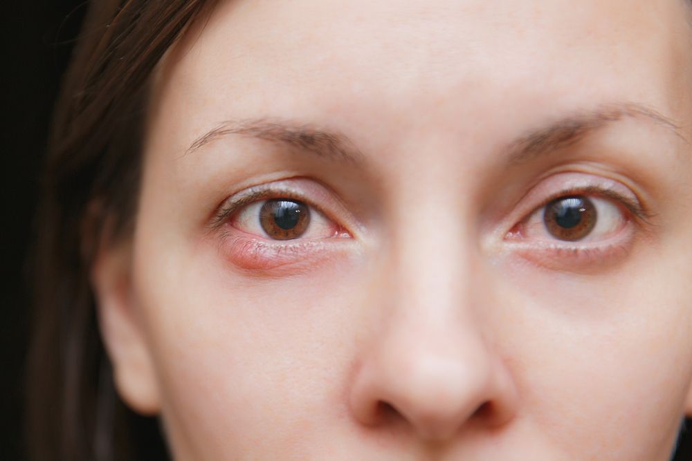 Meibomianitis Made Simple: How to Recognize and Treat Meibomian Gland Dysfunction