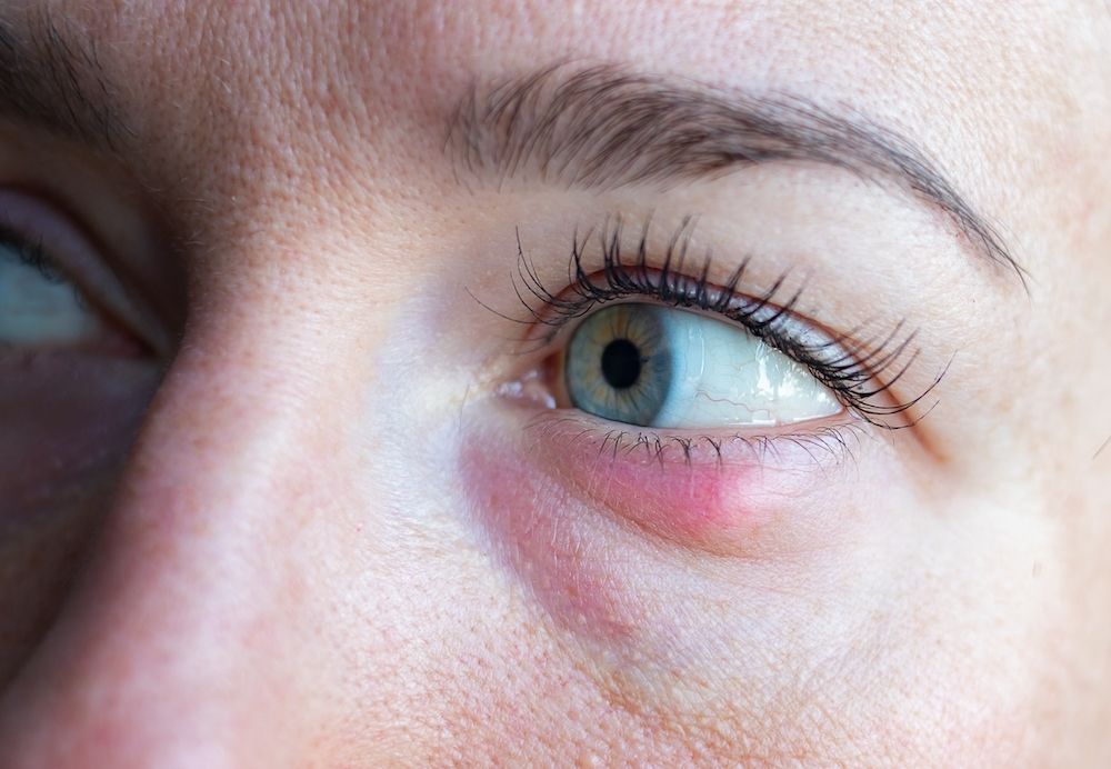 What Is Blepharitis?