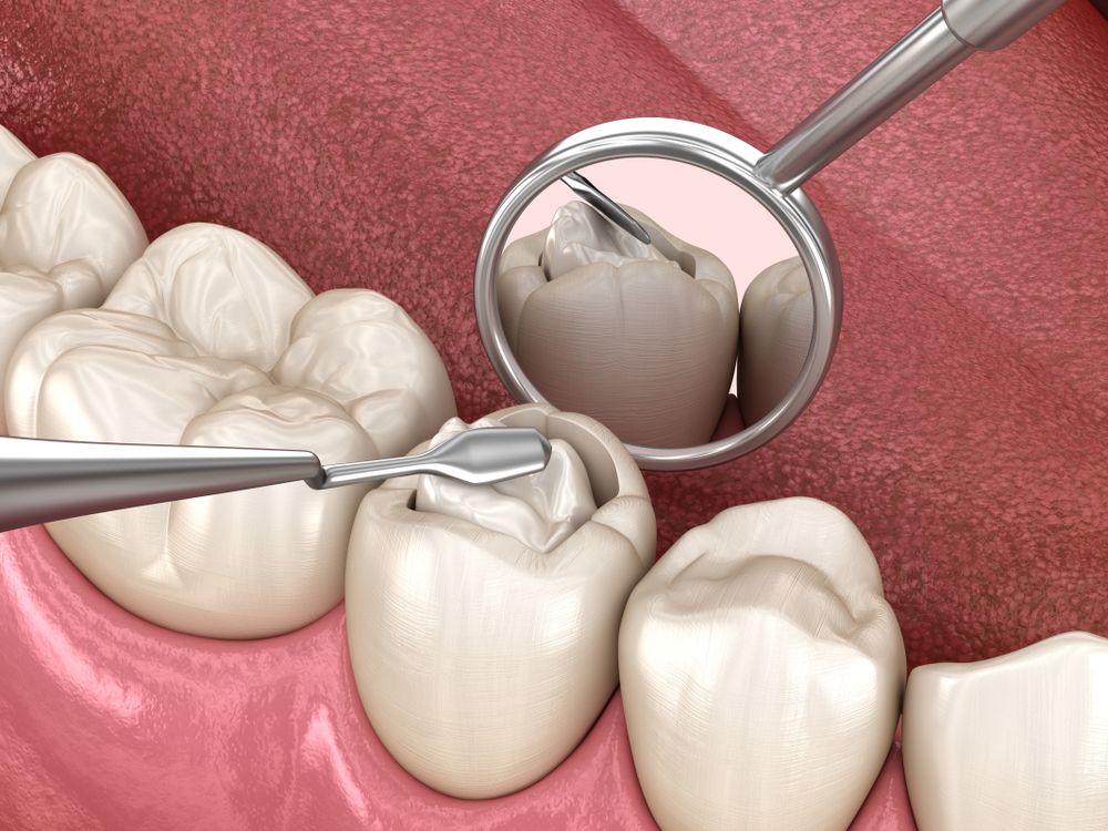 Composite Fillings: A Modern Solution for Family Dental Care