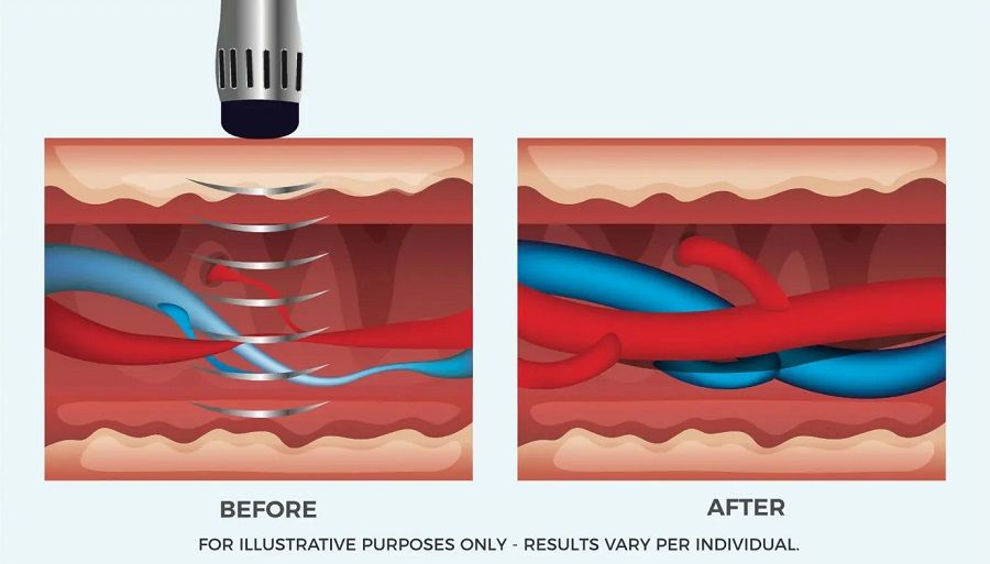 shockwave therapy