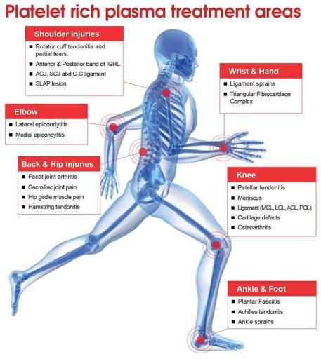 PRP treatment