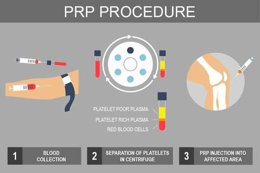 PRP procedure