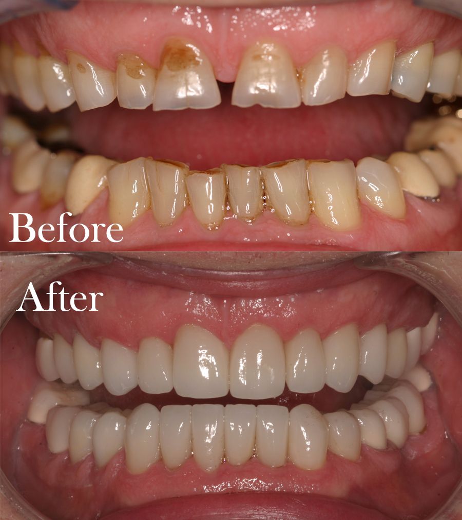 before and after dental procedure