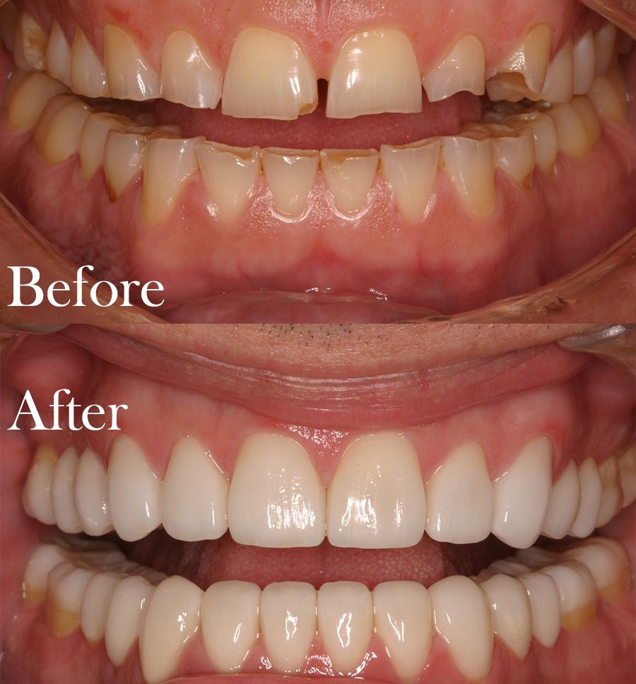 before and after dental procedure