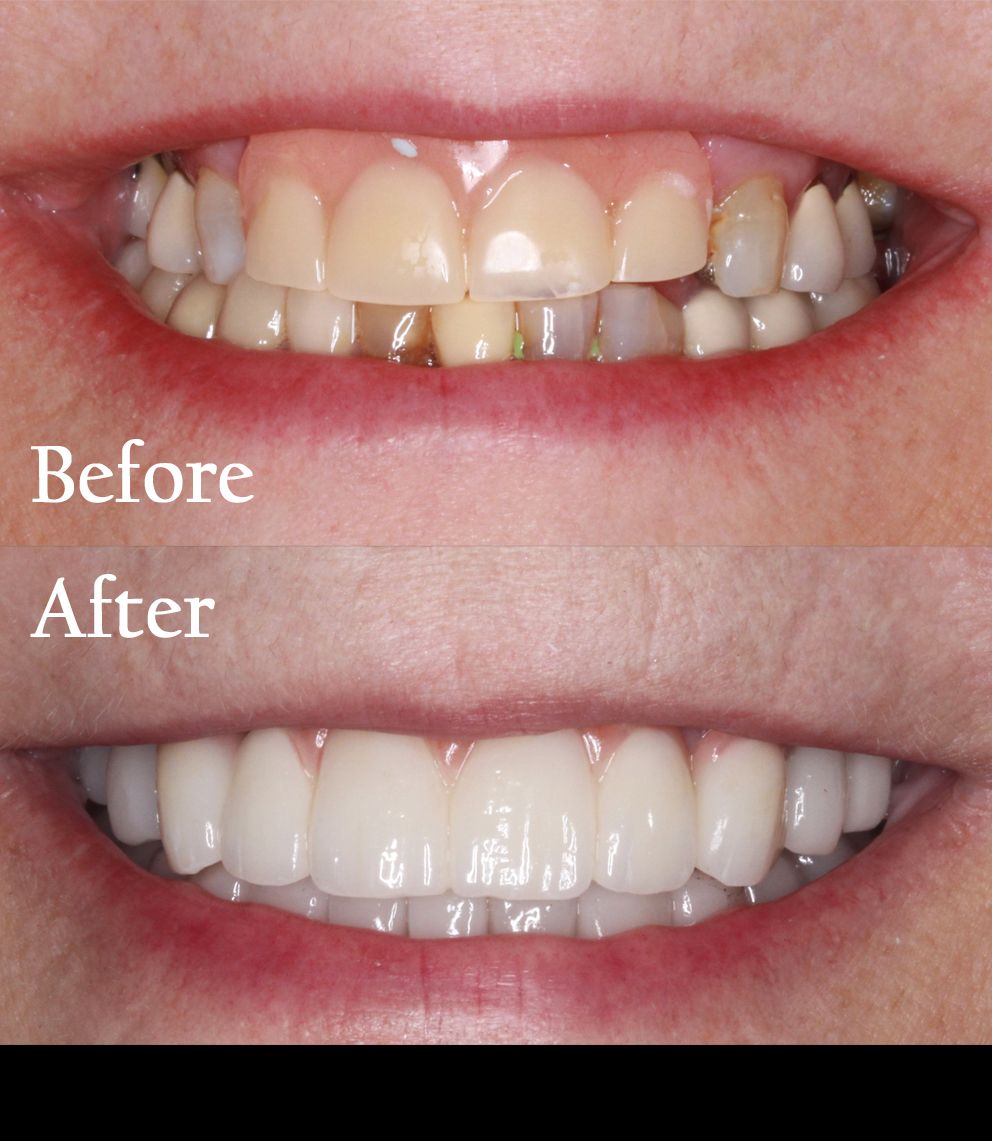 before and after dental procedure