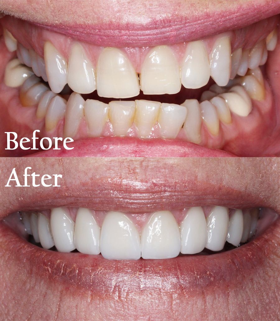 before and after dental procedure