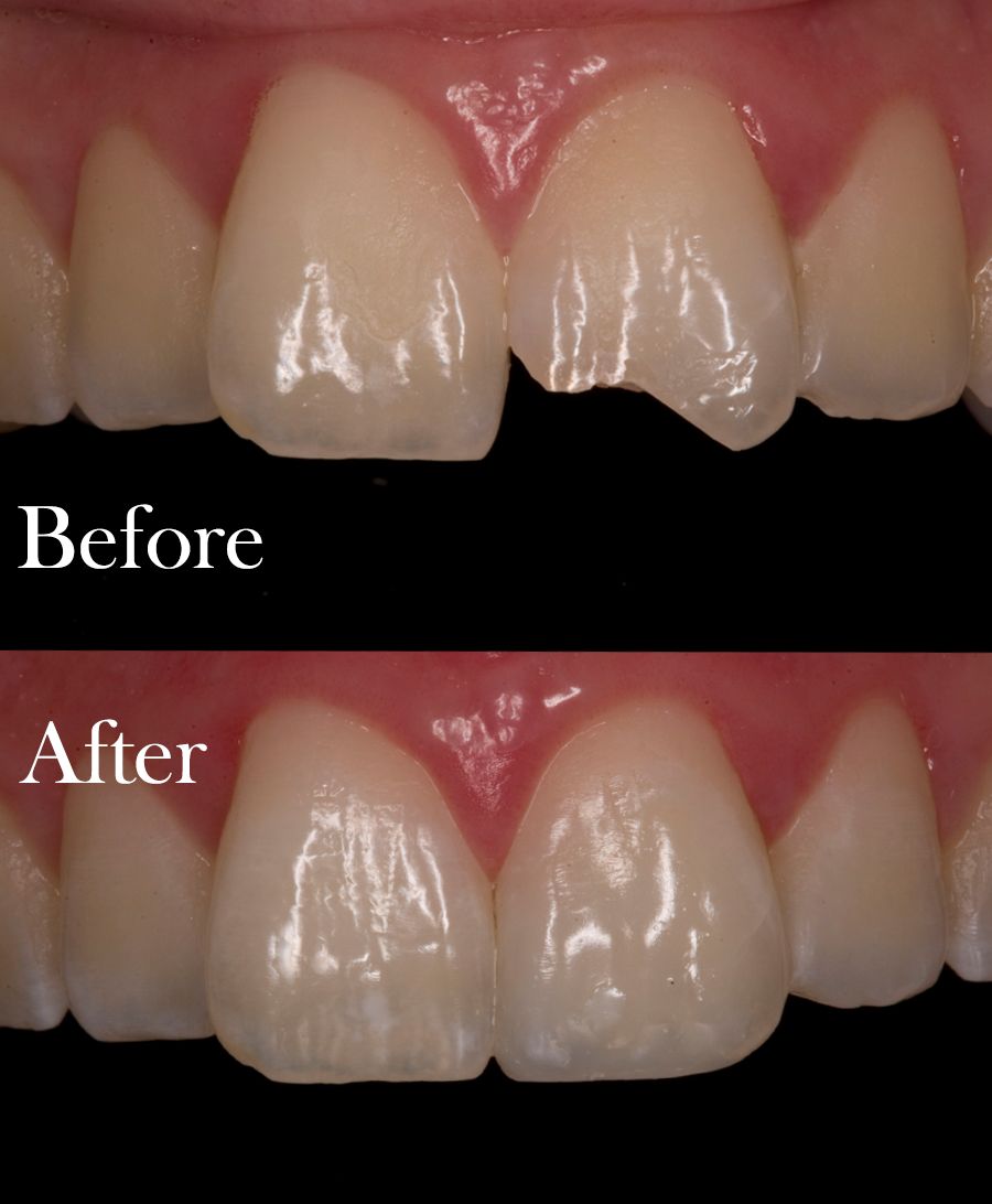 before and after dental procedure