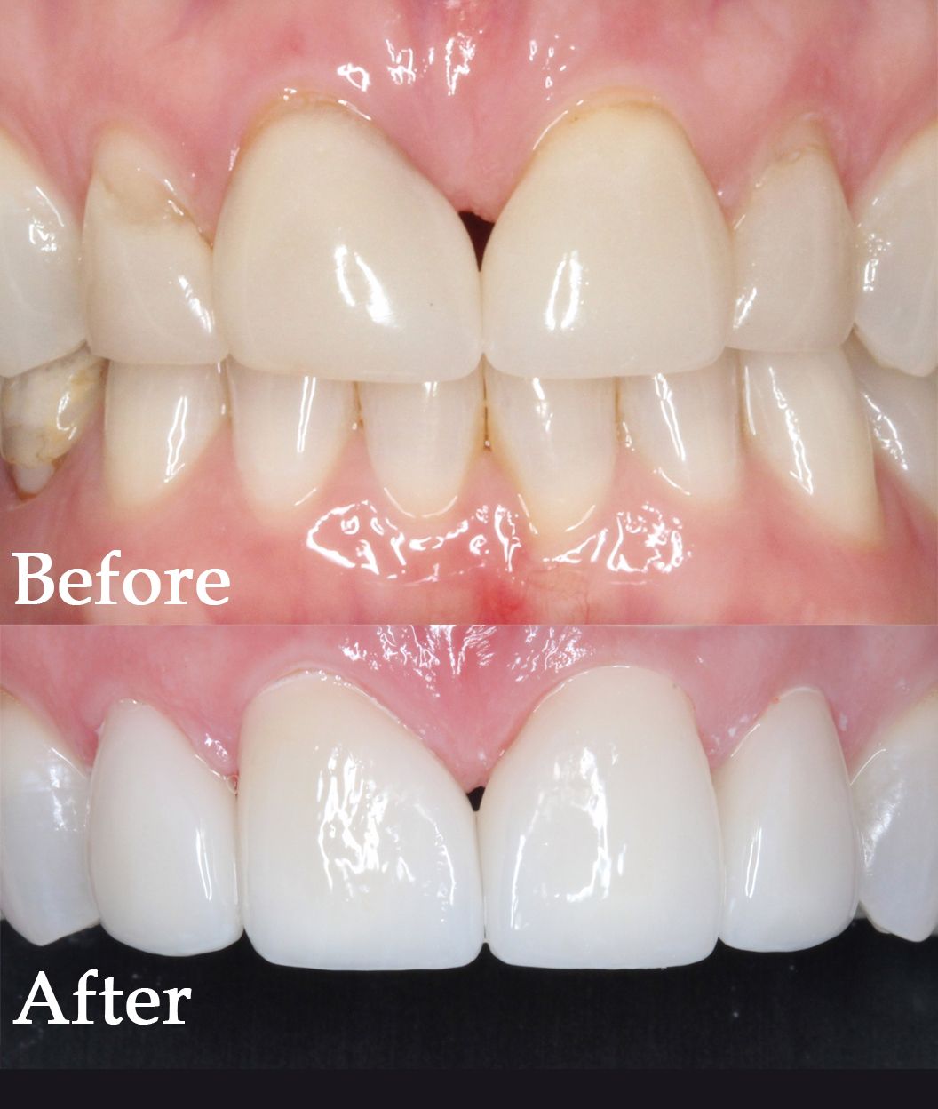 before and after dental procedure