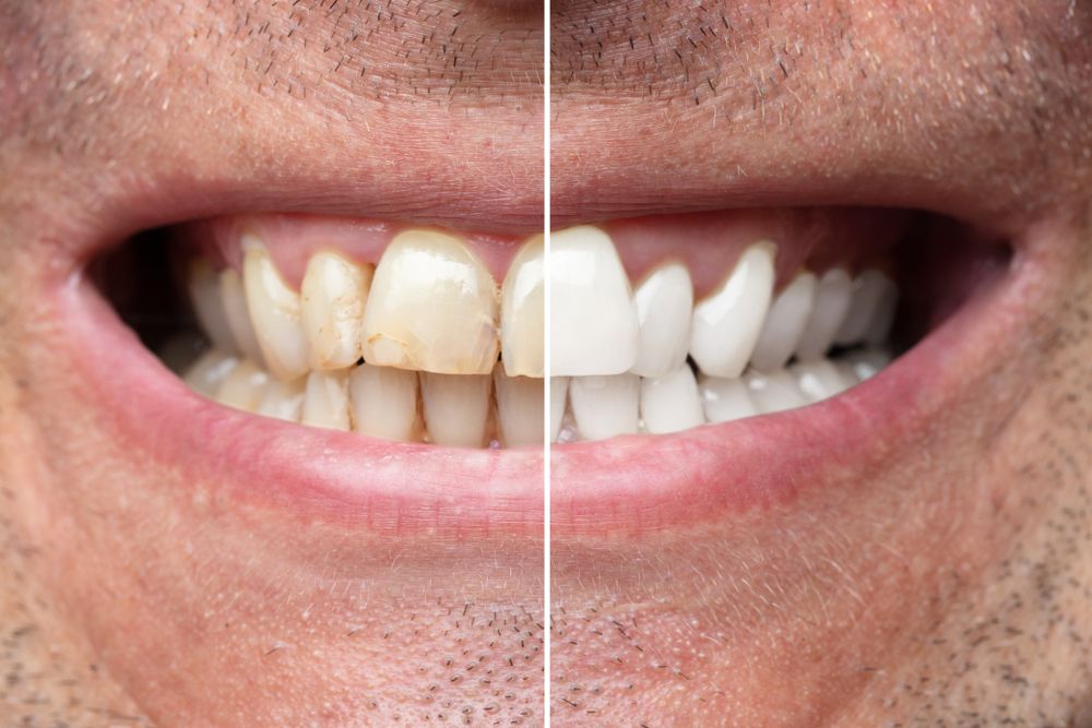 Tooth Discoloration​​​​​​​