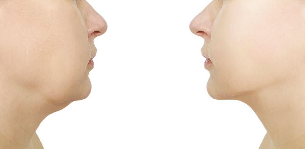 Kybella