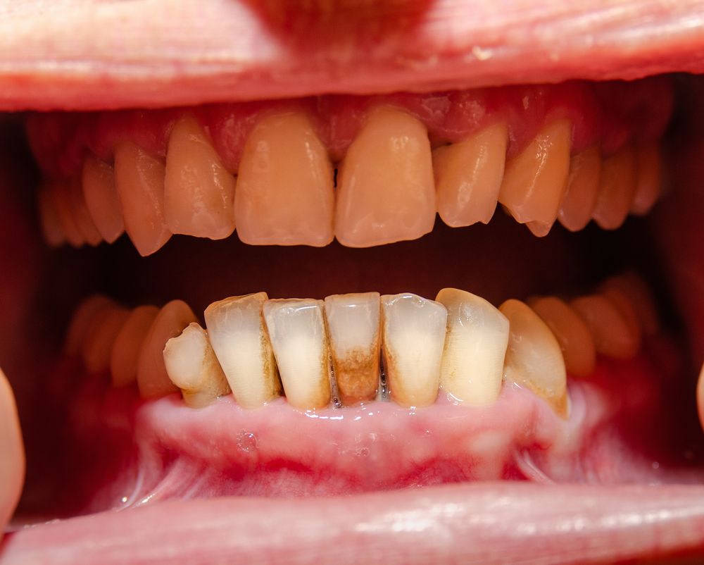 Gum Disease on Health​​​​​​​