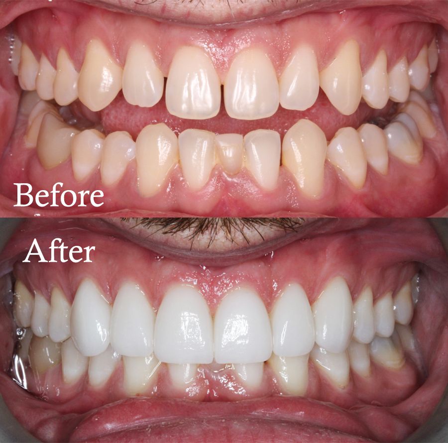 before and after dental procedure