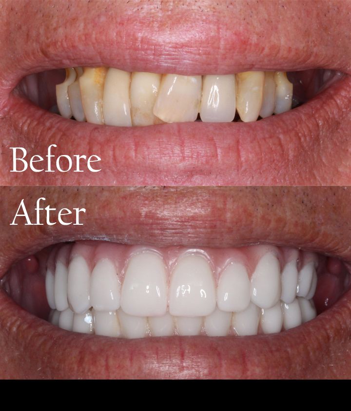 before and after dental procedure