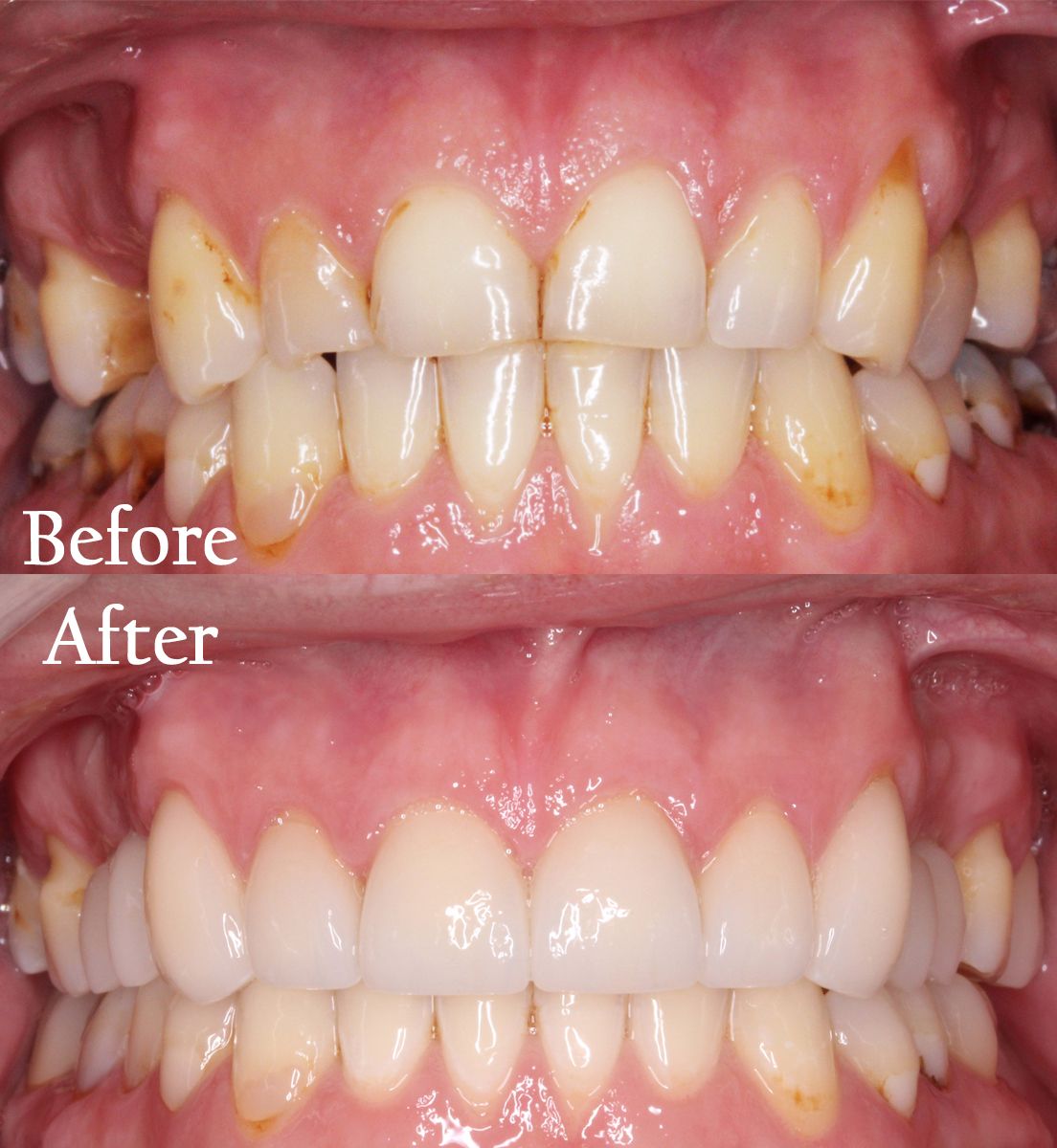 before and after dental procedure