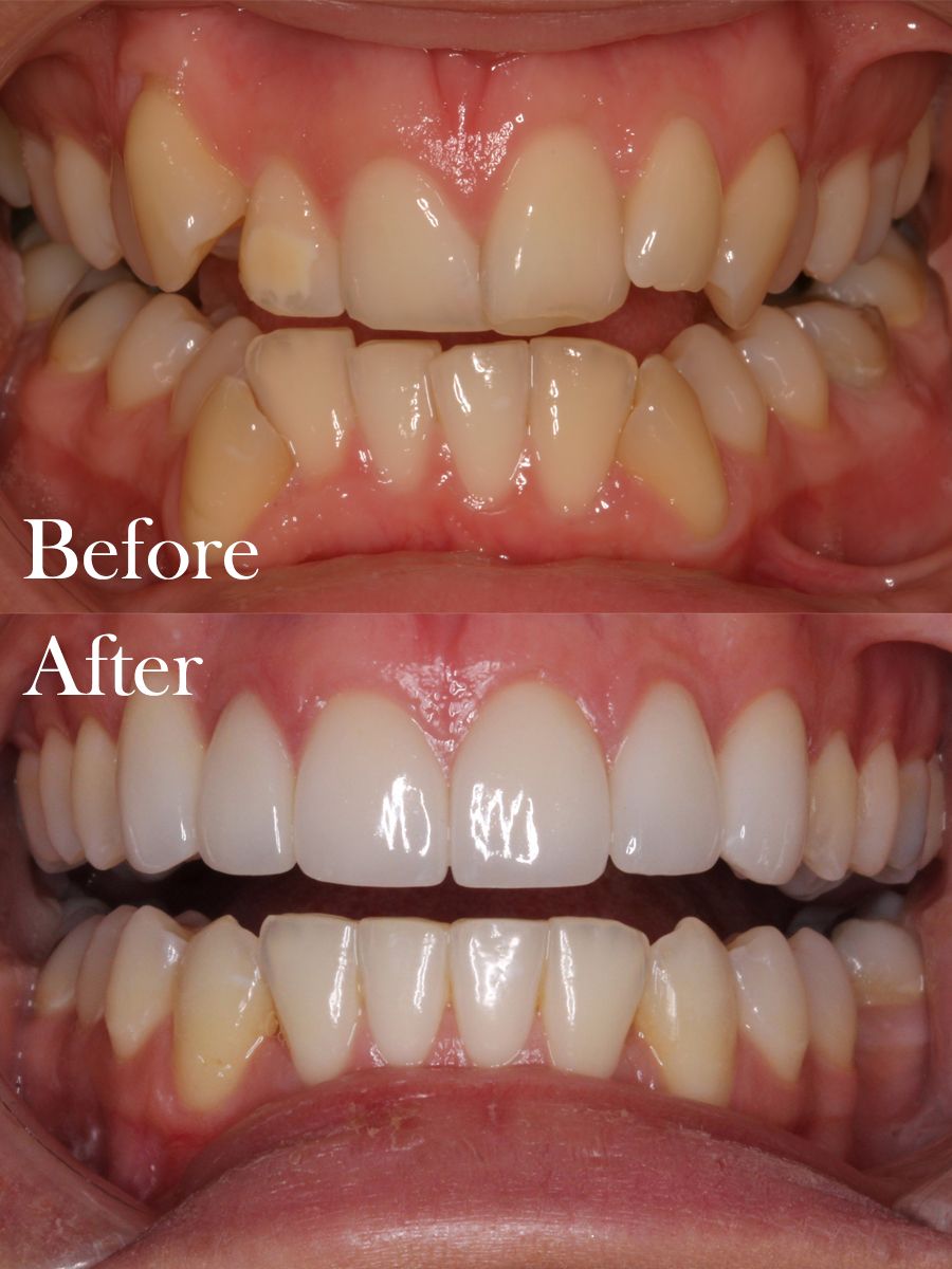 before and after dental procedure