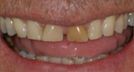 before dental procedure