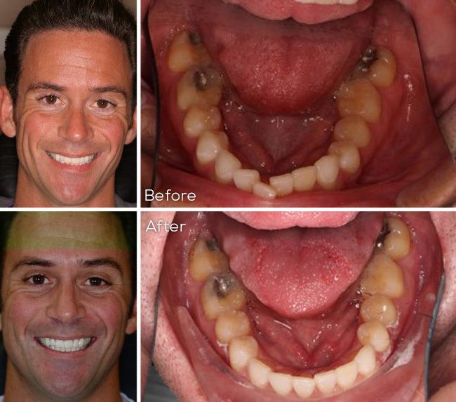 before and after dental procedure
