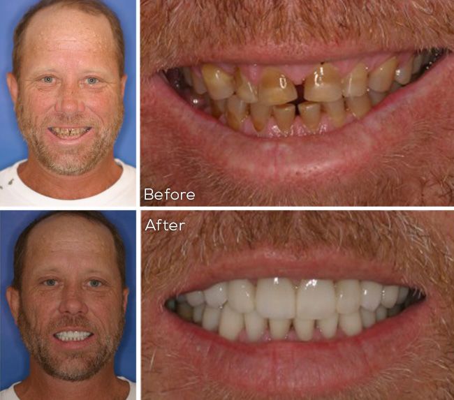 before and after dental procedure