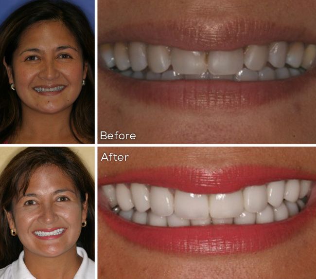 before and after dental procedure