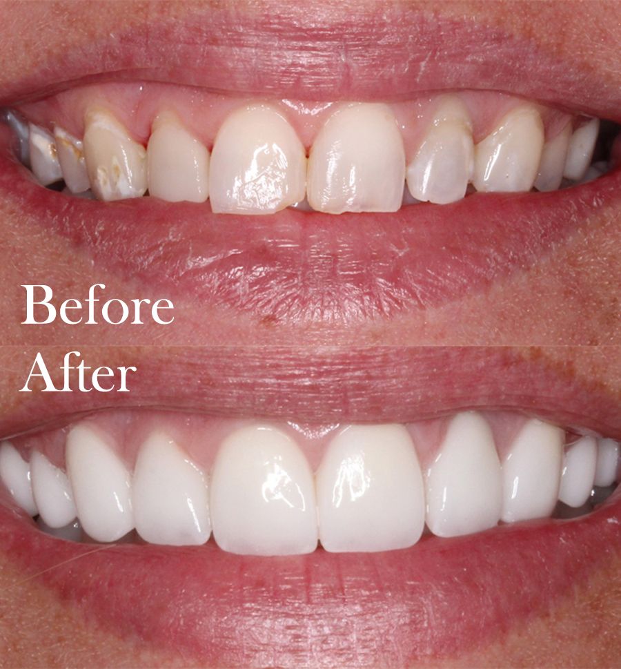 before and after dental procedure