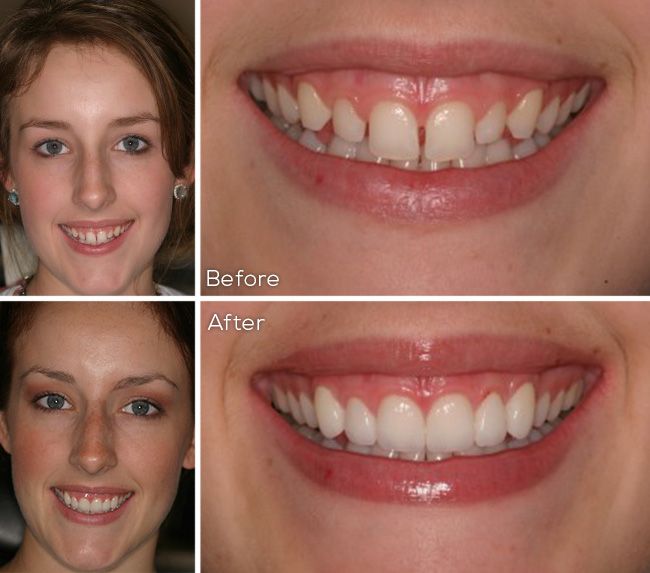 before and after dental procedure