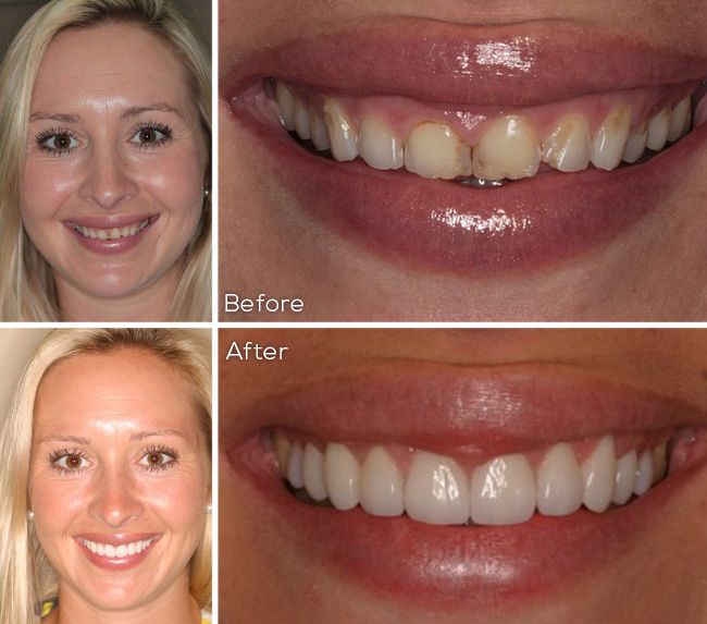 before and after dental procedure