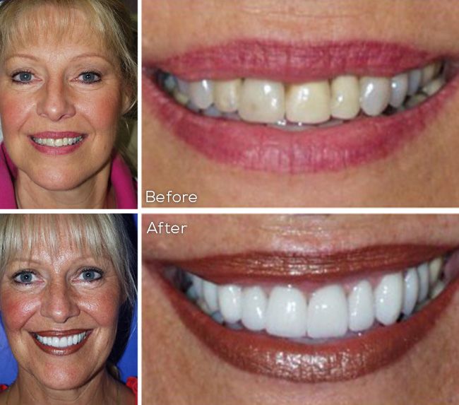 before and after dental procedure