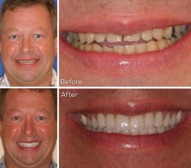 before and after dental procedure