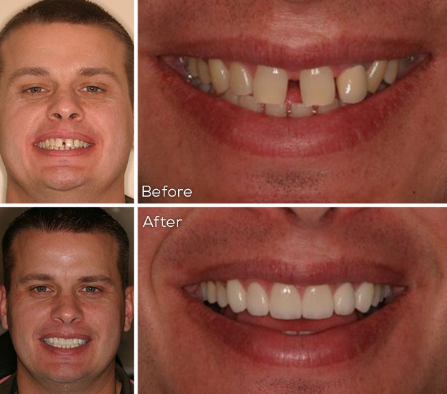 before and after dental procedure