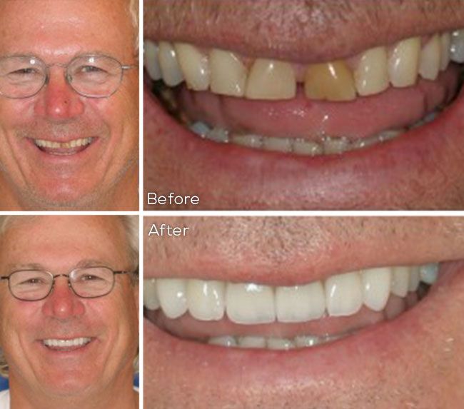 before and after dental procedure