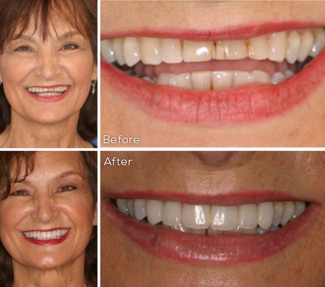 before and after dental procedure