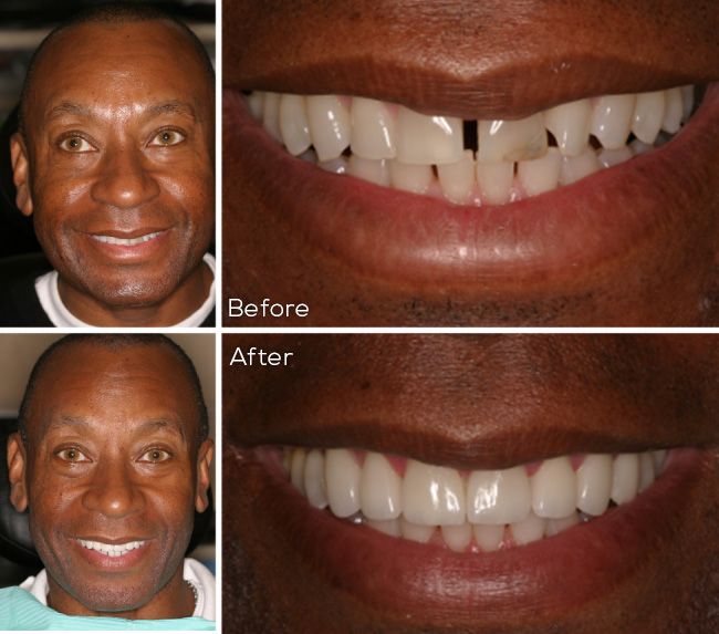 before and after dental procedure